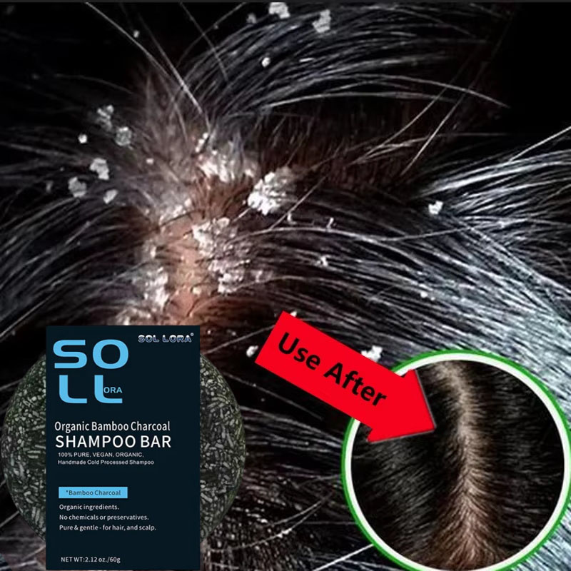 Snelle Anti Roos Haarbehandeli - Hair Care Dandruff recensie en prijs